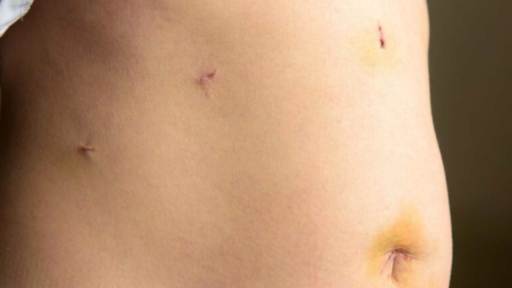 miomas