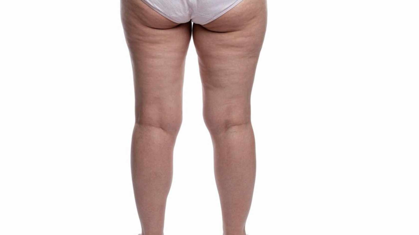 Lipedema