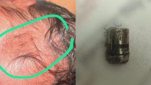 Recém-nascida Bala Tiro Hospital