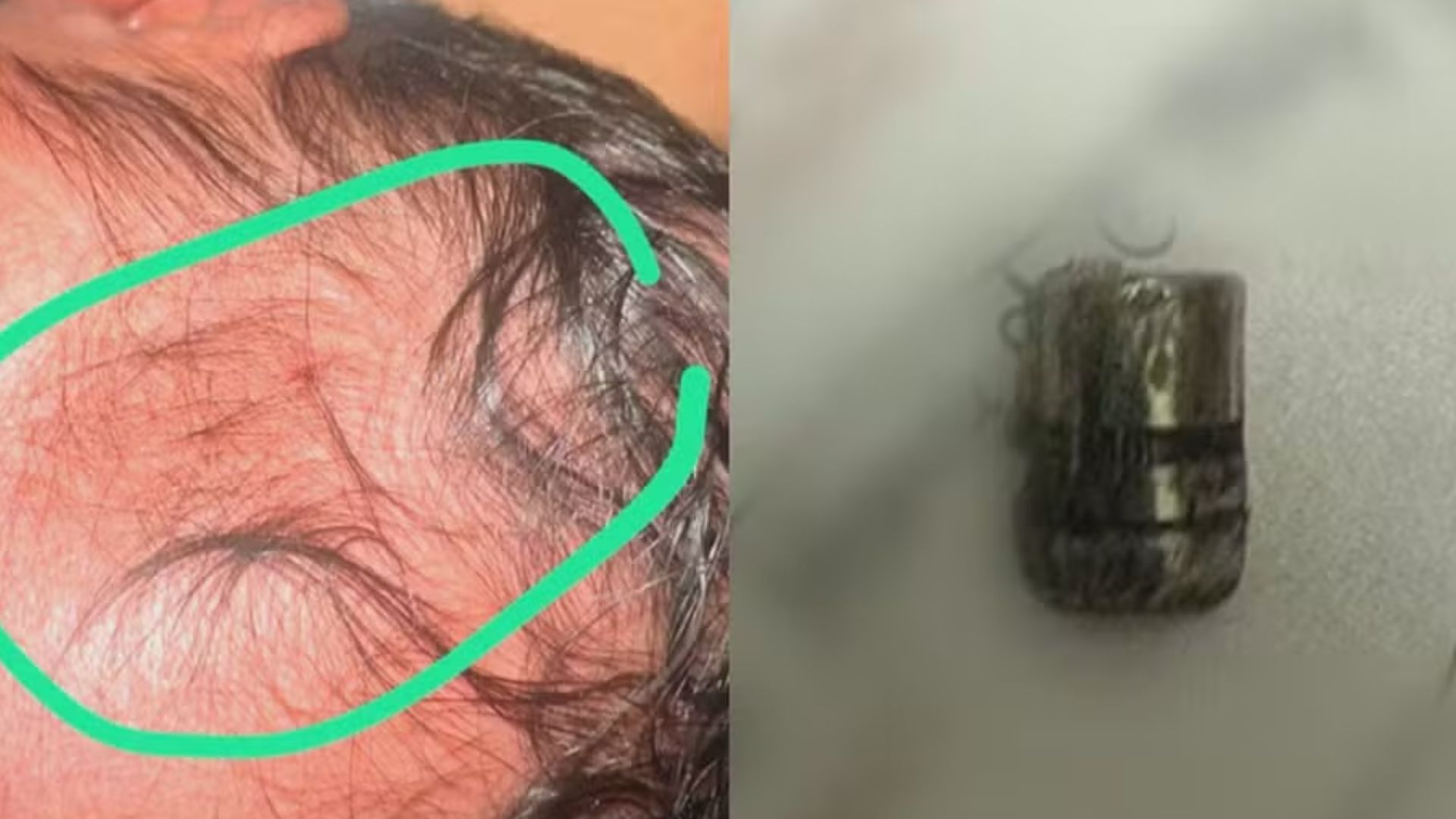 Recém-nascida Bala Tiro Hospital