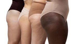 lipedema