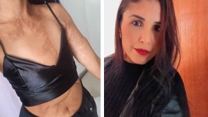 corpo queimado Serra