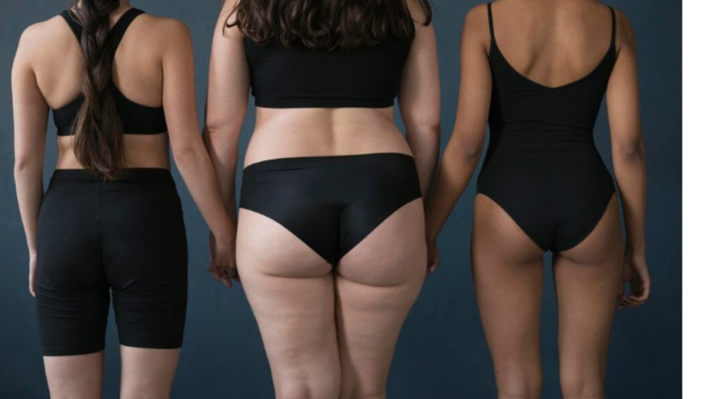 lipedema