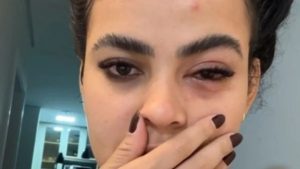 Influenciadora Mosca de banheiro Infecção no olho