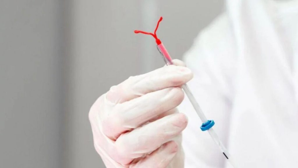 DIU hormonal para endometriose
